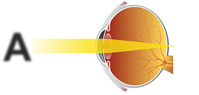 Дальнозоркий (гиперметропичный) глаз, лечение направлено на изменение фокуса