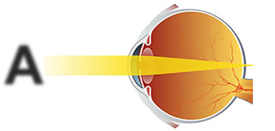 Пресбиопичный глаз (глаз с возрастной дальнозоркостью), лечение направлено на изменение положения фокуса