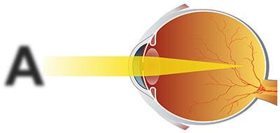 Близорукий (миопичный) глаз, лечение направлено на изменение положения фокуса
